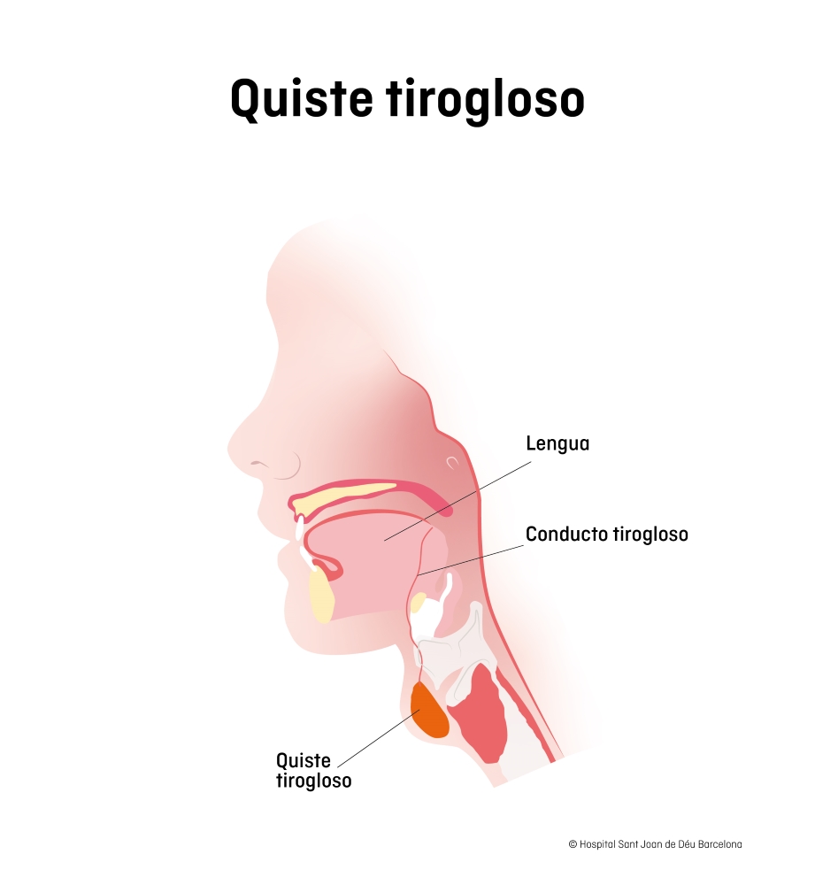 Quiste Tirogloso Escola De Salut Sjd 3541